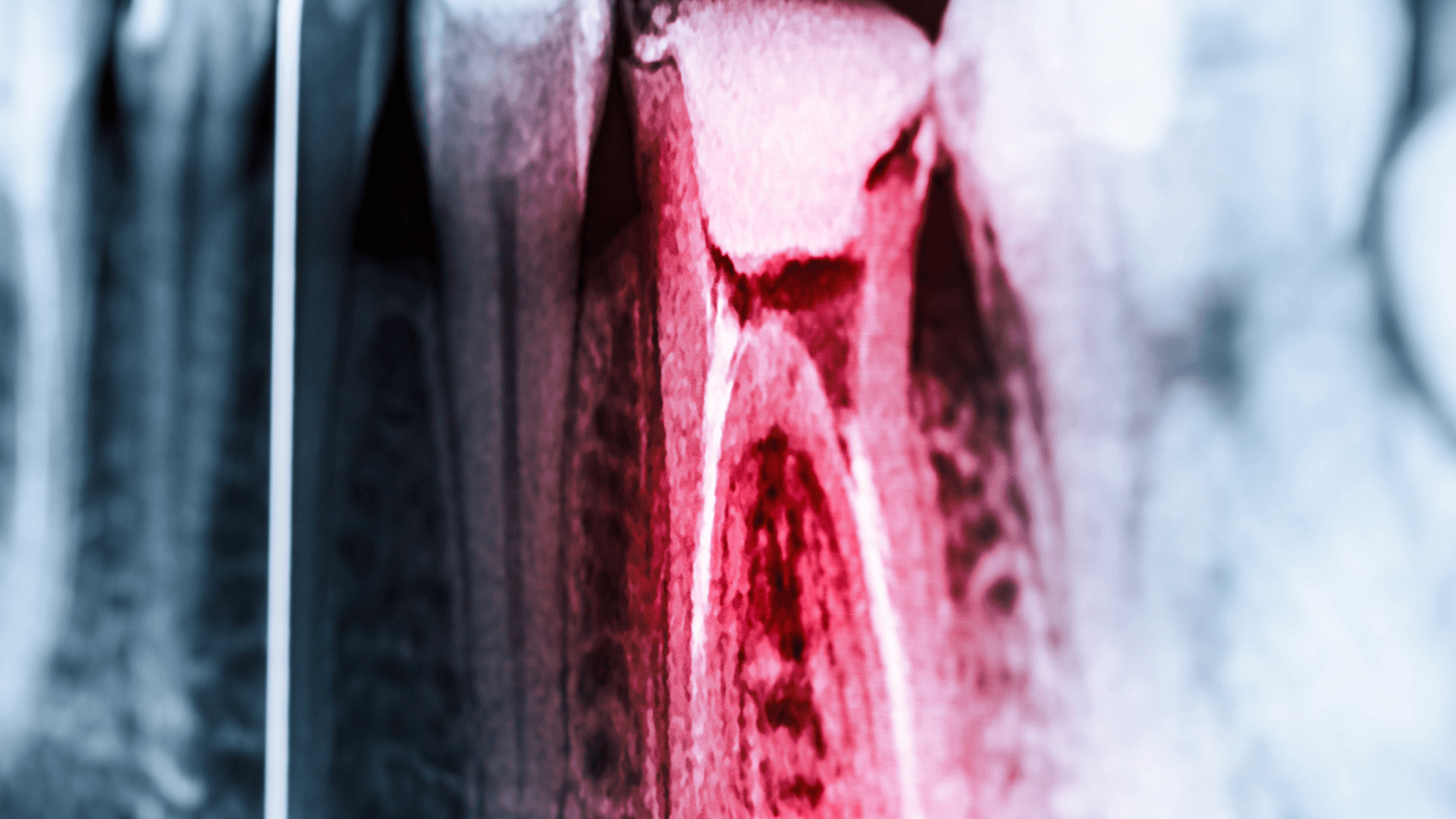 Step-by-Step: What Happens During a Root Canal