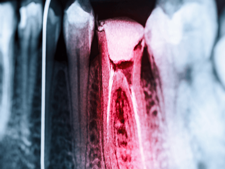 Step-by-Step: What Happens During a Root Canal