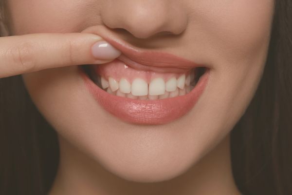 gum contouring in Hatfield - photo of a woman's face, she is holding her top lip up to show her teeth and gums