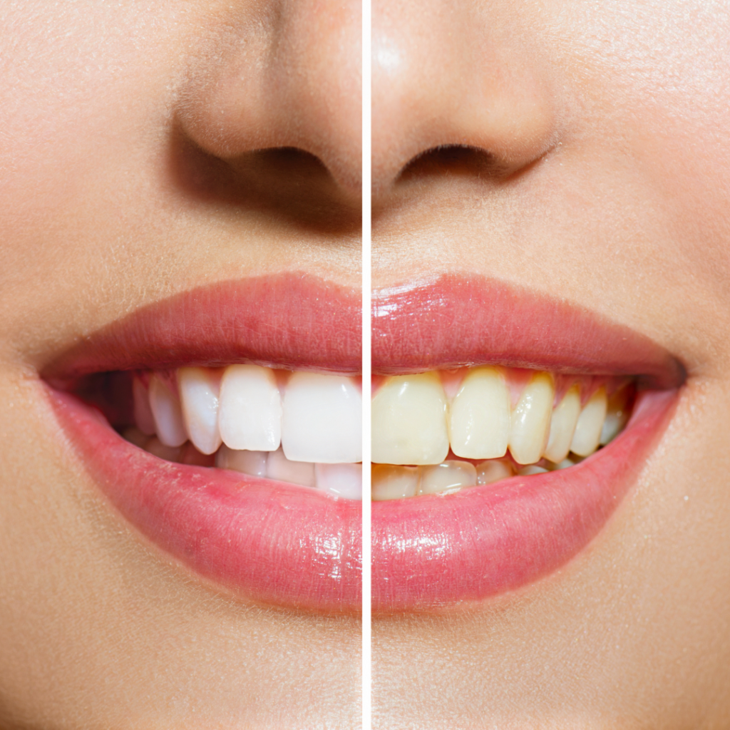 Whitening