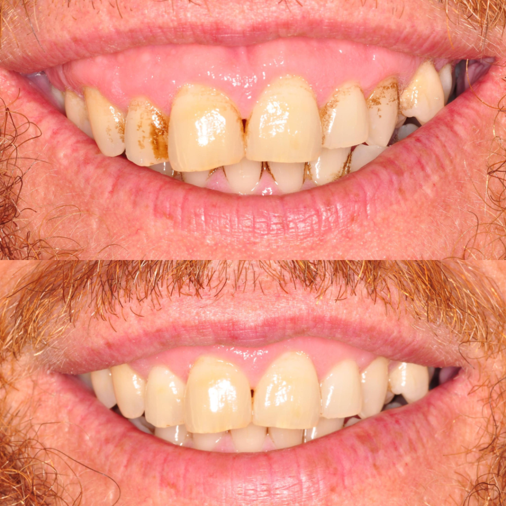 Gummy Smile Before and after